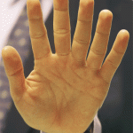 hand with 6 fingers